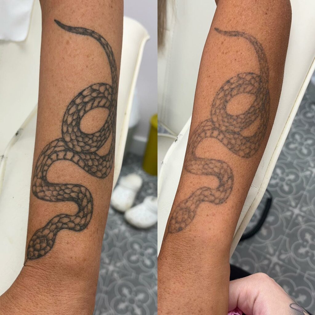 Tattoo Removal