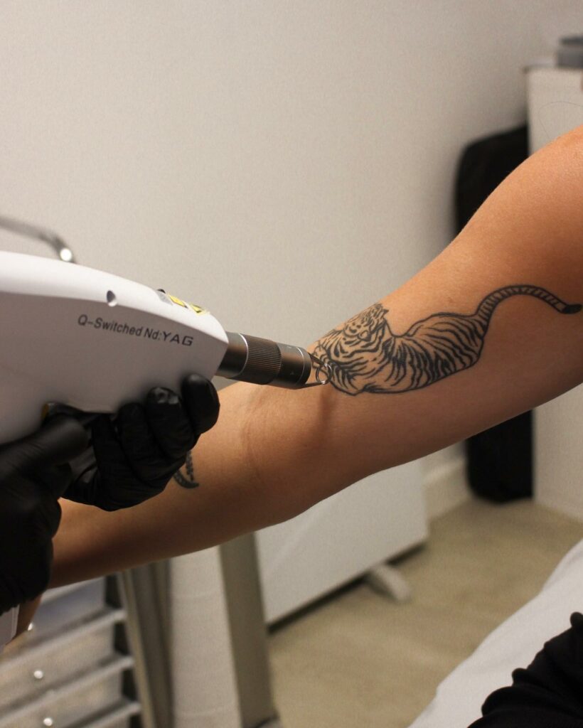 Tattoo Removal