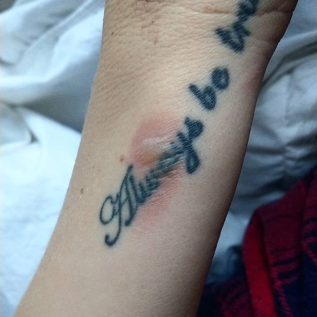 Tattoo Burn